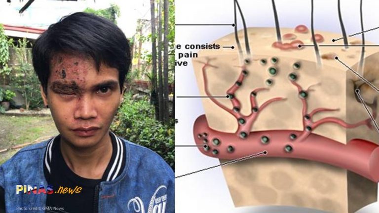 Binulutong ang mukha sa pagpahid ng pekeng Beauty Cream