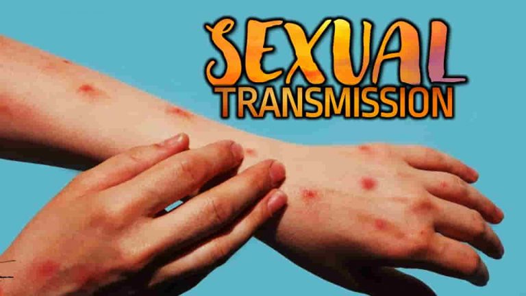 Monkeypox kumakalat dahil sa sexual transmission